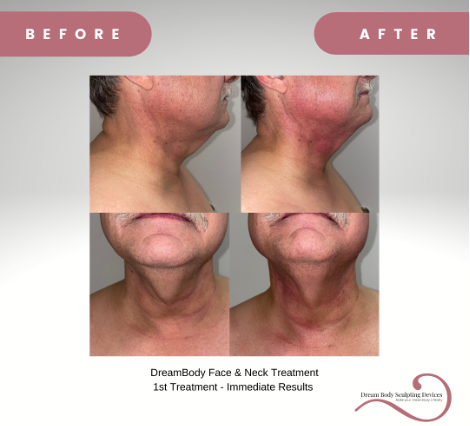 DreamBody Face and Neck Treatment