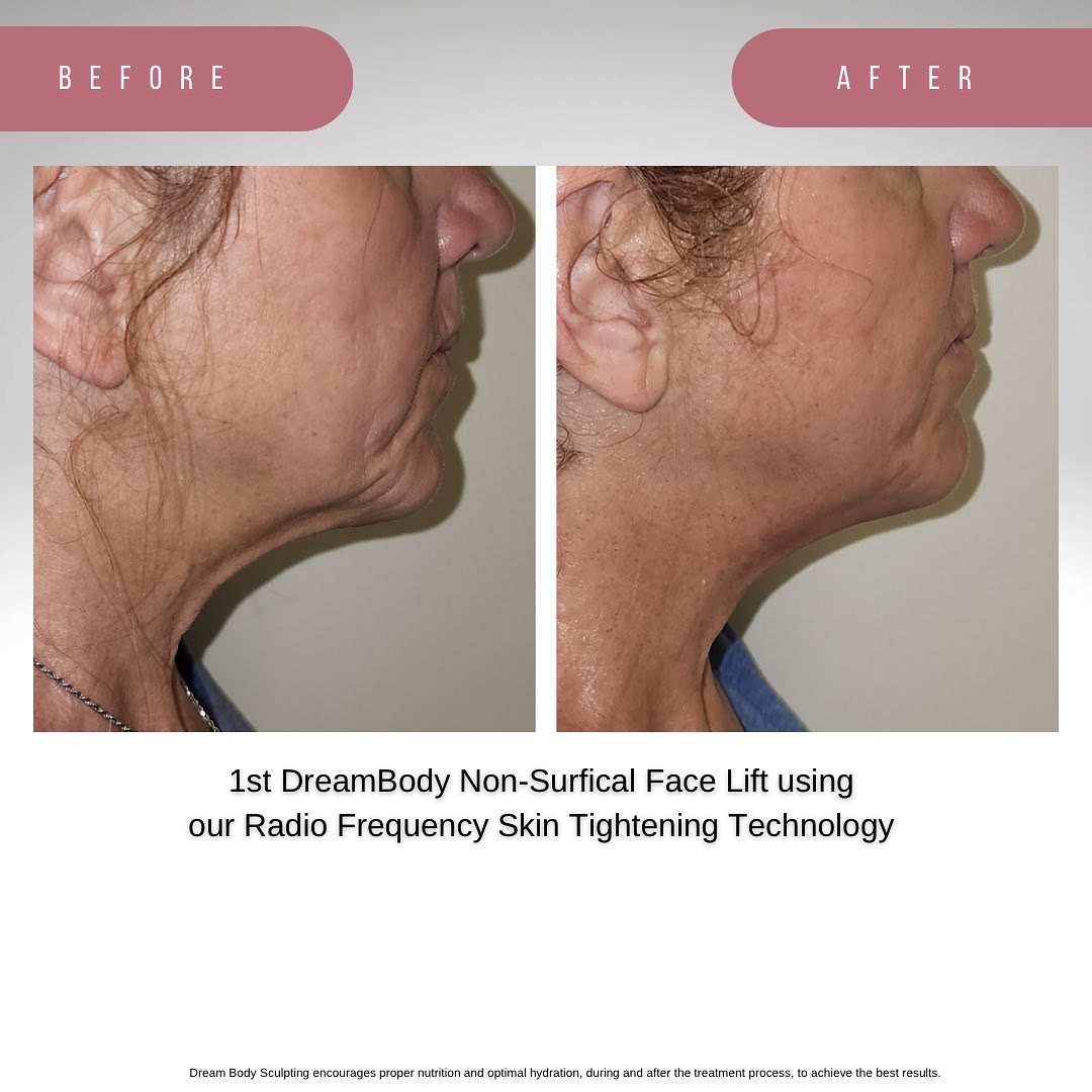 Non-surgical Face and Neck Treatment