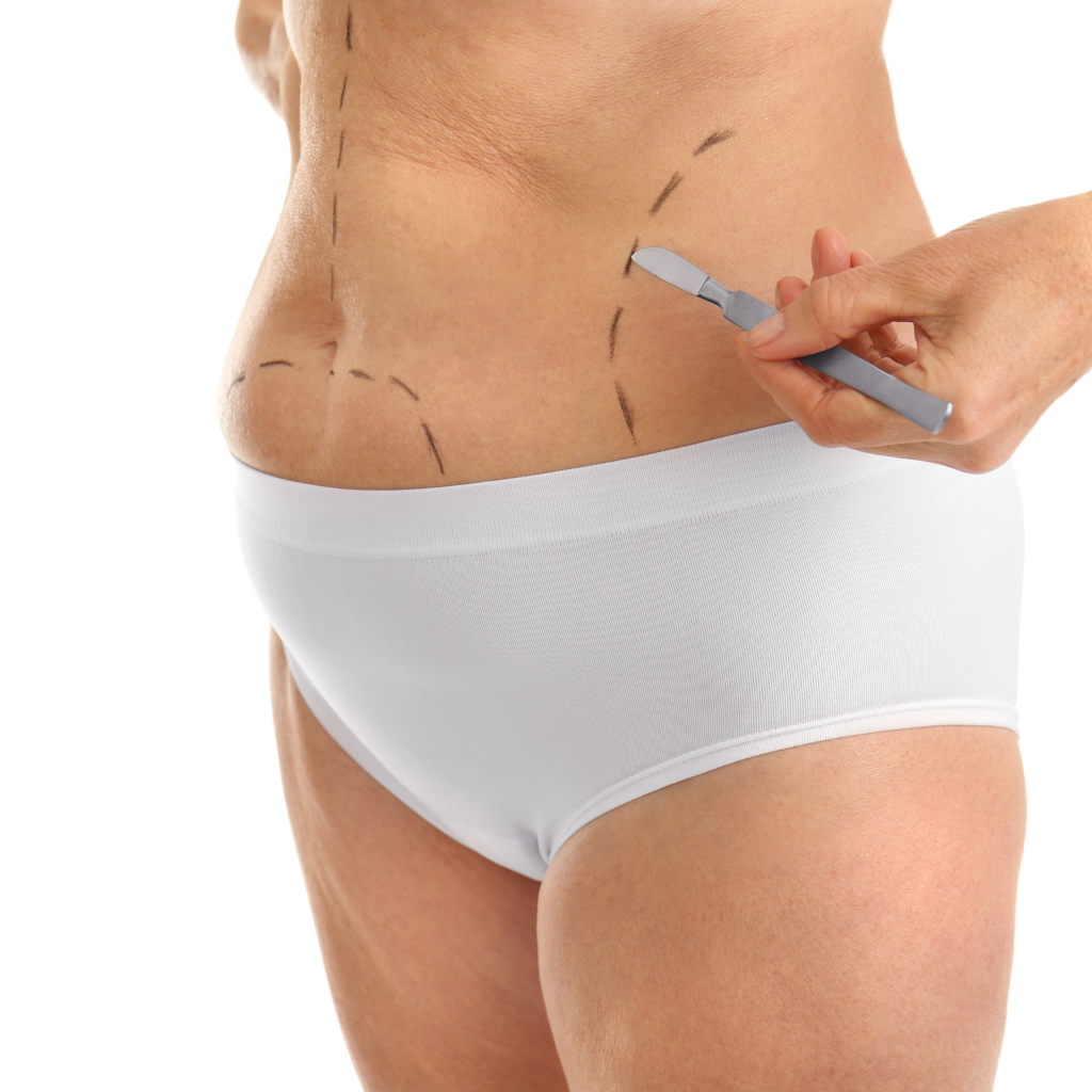 liposuction