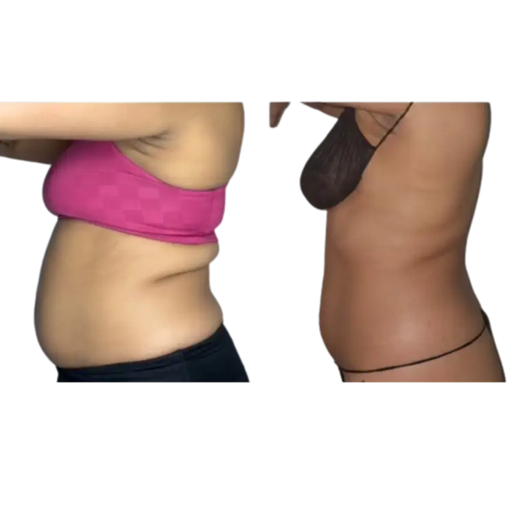 DreamBody™ ELITE Body contouring machine before and afters