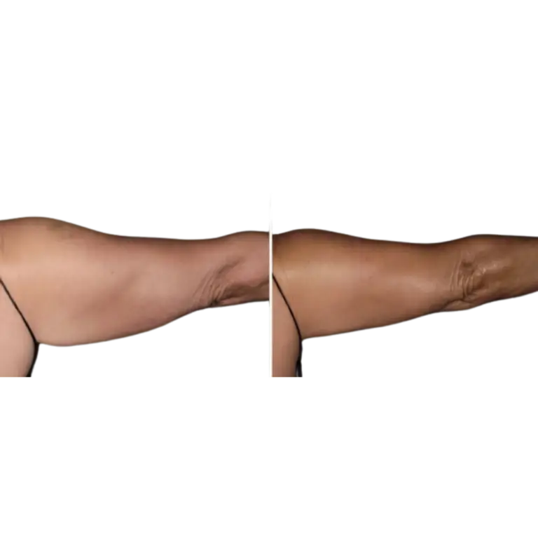 DreamBody™ ELITE Body contouring machine before and afters