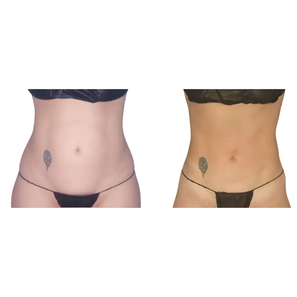 DreamBody™ ELITE Body contouring machine before and afters